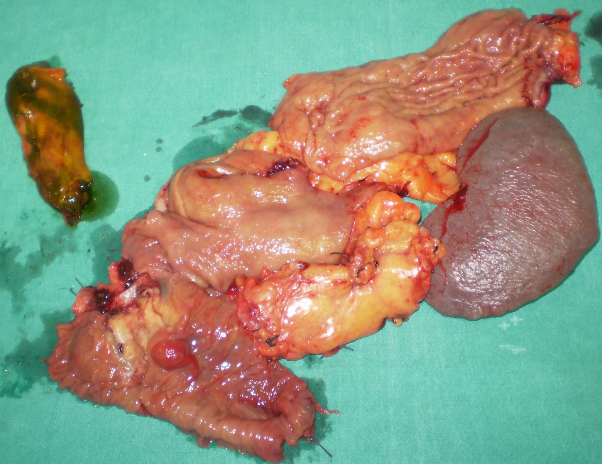 TOTAL PANCREATECTOMY