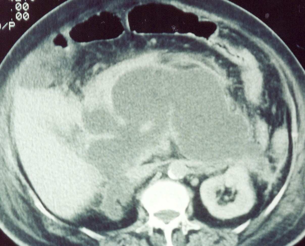 PANCREATIC ABSCESS