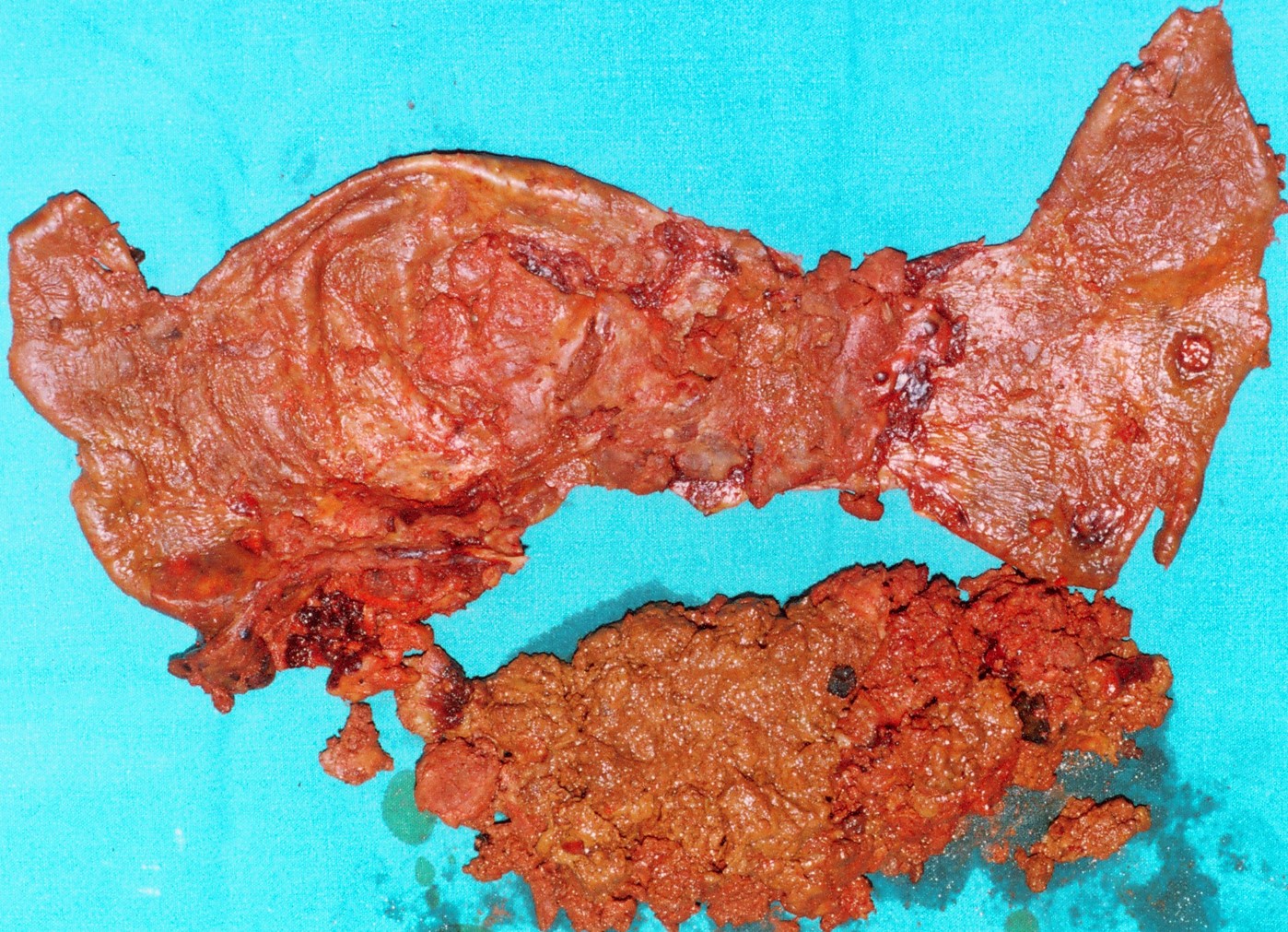 PANCREATIC ABSCESS EVACUATED 