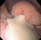 PANCREATIC ABSCESS