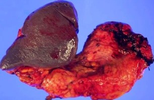 PANCREATIC CYSTIC LYMPHANGIOMA