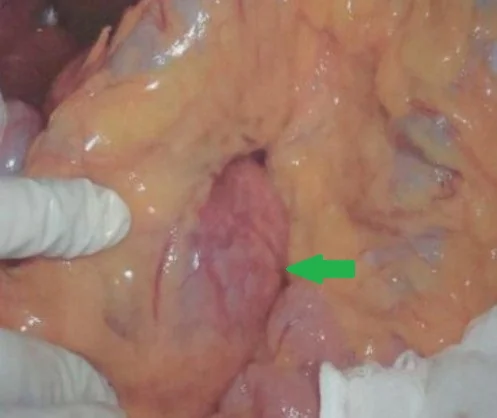 PANCREATIC GIST