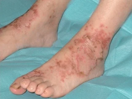 NECROLYTIC MIGRATORY ERYTHEMA