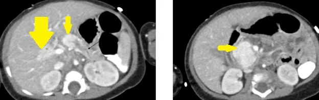 PANCREATIC HAEMANGIOENDOTHELIOMATOSIS