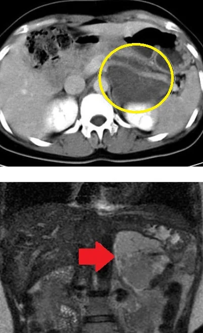 PANCREATIC HEMANGIOMA