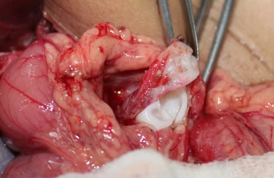 PANCREATIC HYDATID CYST