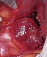 PANCREATIC HUDATID CYST