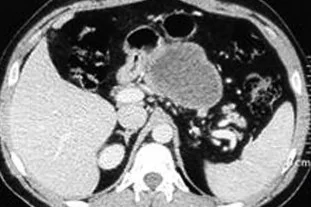 PANCREATIC HYDATID CYST