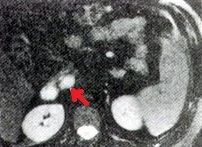 PANCREATIC INSULINOMA