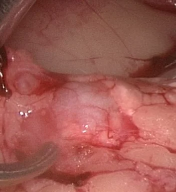 PANCREATIC INSULINOMA