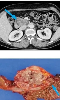 PANCREATIC INTRADUCTAL MUCINOUS NEOPLASM