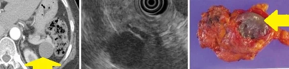 PANCREATIC LYMPHOEPITHELIAL CYST