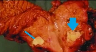 PANCREATIC LYMPHOEPITHELIAL CYST