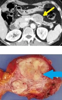 PANCREATIC METASTATIC LEIOMYOSARCOMA