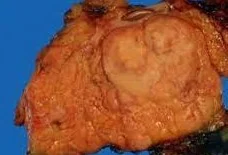 PANCREATIC MiNEN