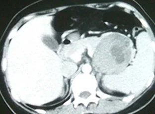 PANCREATIC MUCINOUS CYSTADENOMA