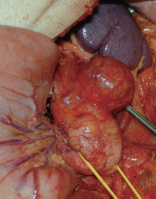 PANCREATIC MUCINOUS NEOPLASM