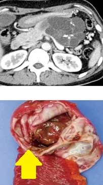 PANCREATIC MUCINOUS NEOPLASM