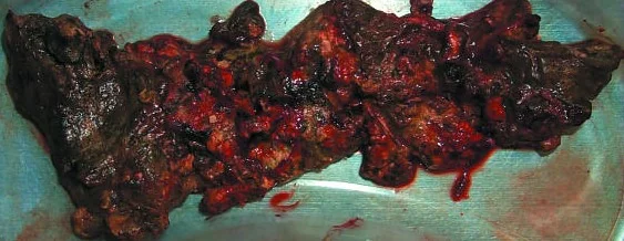 PANCREATIC NECROSECTOMY