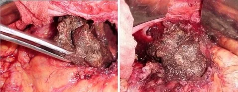 PANCREATIC NECROSECTOMY