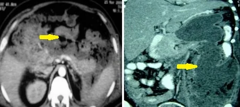 PANCREATIC NECROSIS