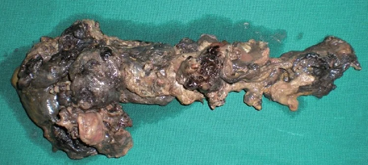 COMPLETE PANCREATIC NECROSIS