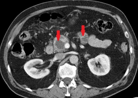 PANCREATIC NEUROENDOCRINE TUMORS
