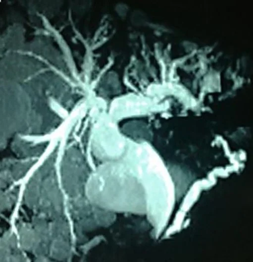 PANCREATIC NEUROENDOCRINE TUMOR
