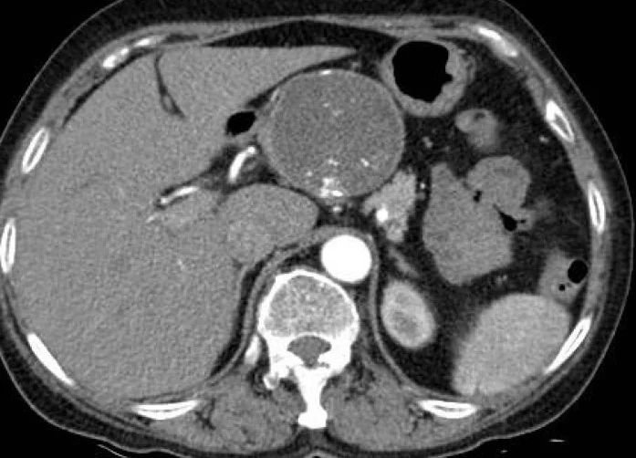 PANCREATIC NON-NEOPLASTIC CYST