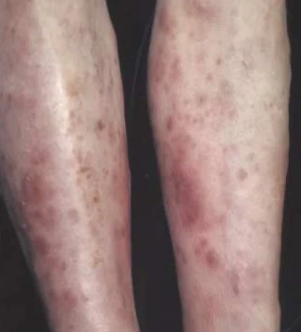 PANCREATIC PANNICULITIS