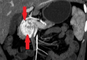 PANCREATIC PARAGANGLIOMA