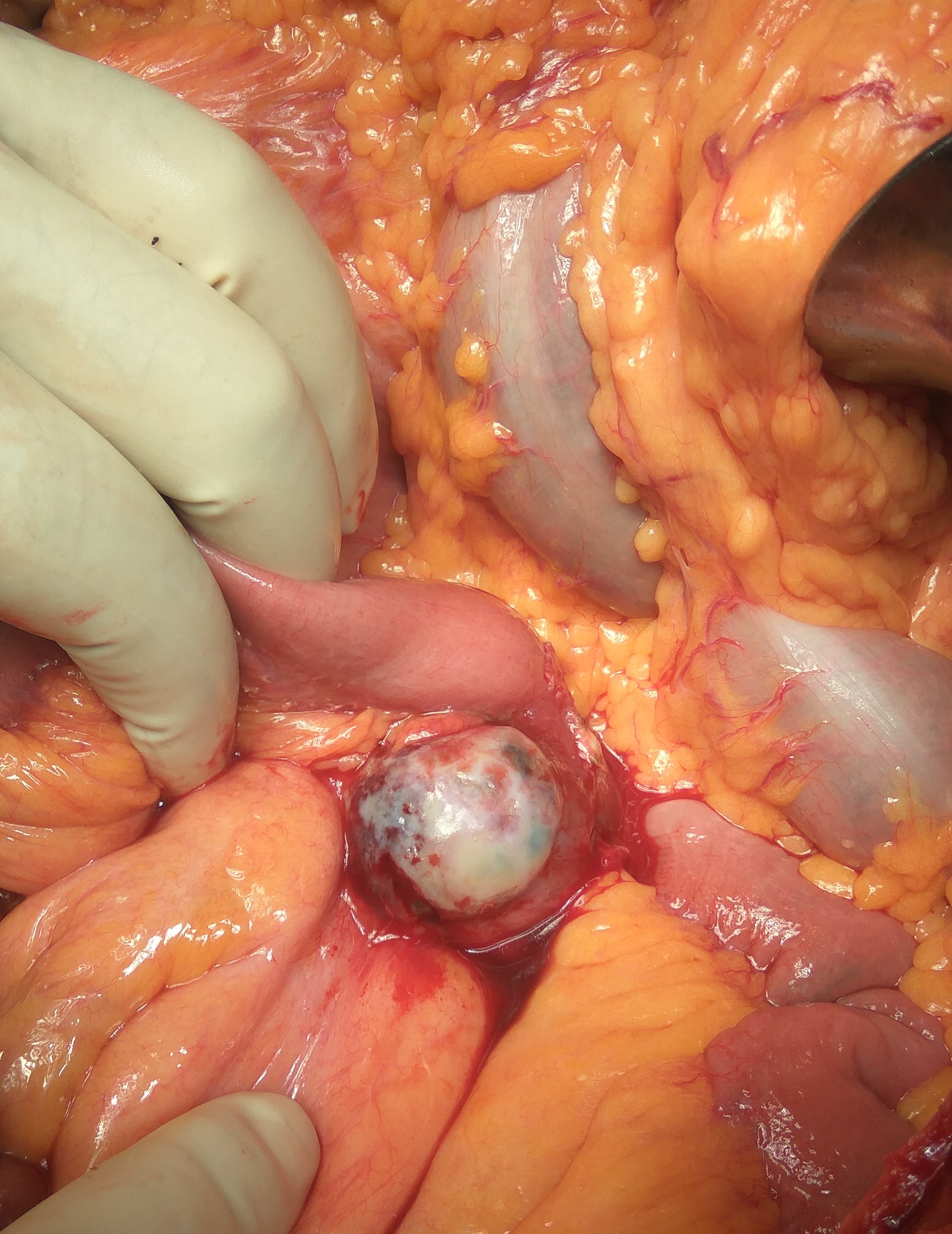 PANCREATIC PSEUDOCYST UNDERLYING MALIGNANCY