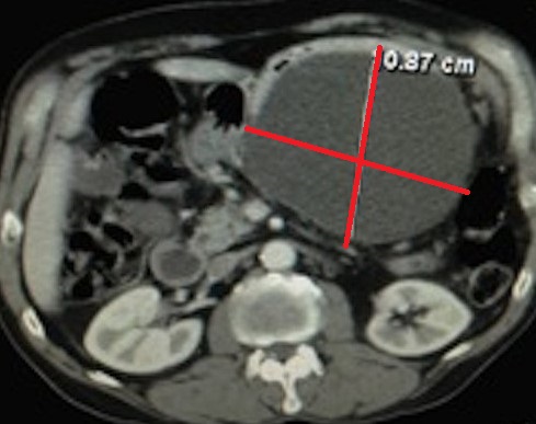 PANCREATIC PSEUDOCYST