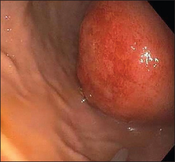 PANCREATIC PSEUDOCYST