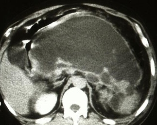 PANCREATIC PSEUDOCYST