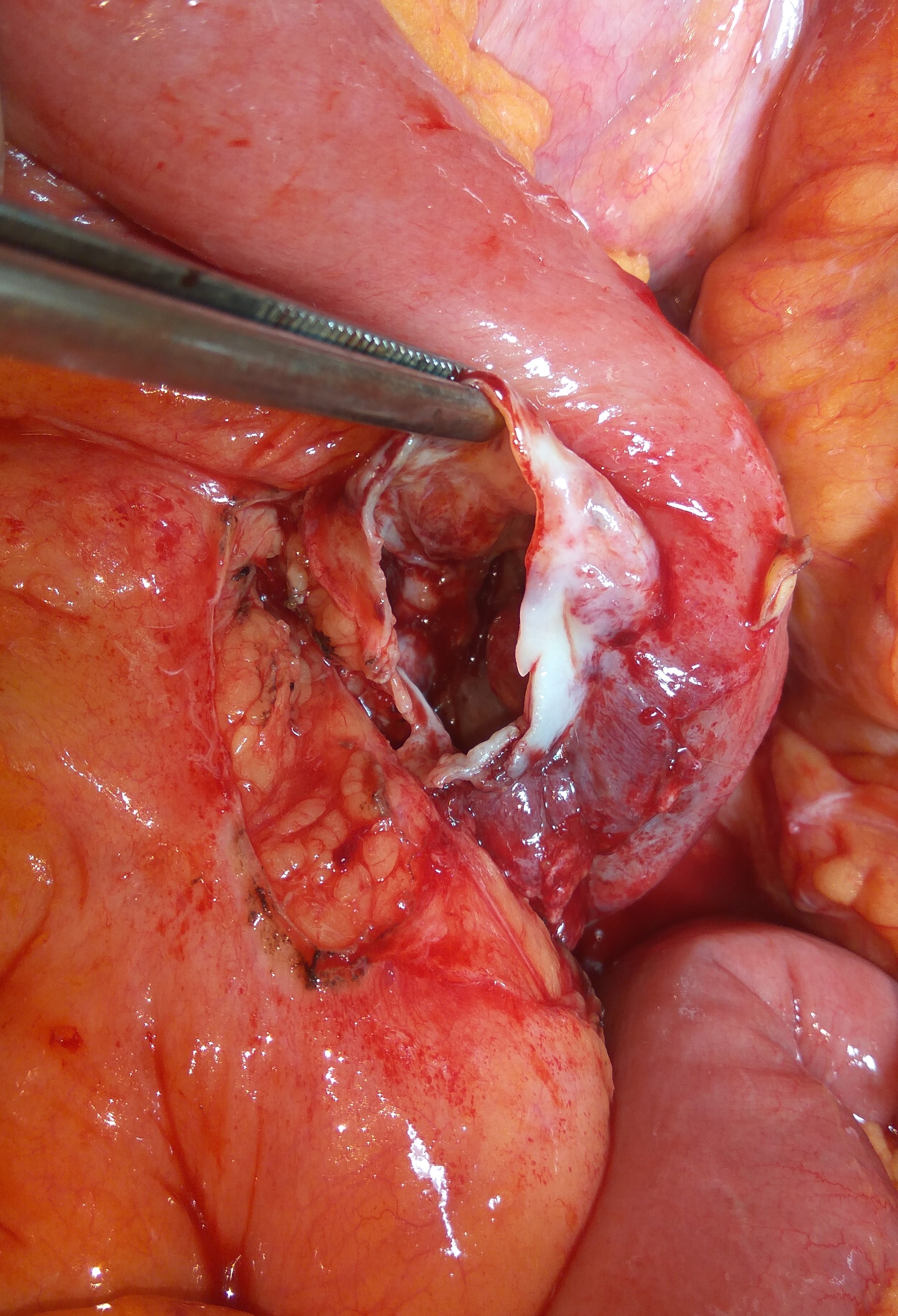 PANCREATIC PSEUDOCYST DRAINAGE