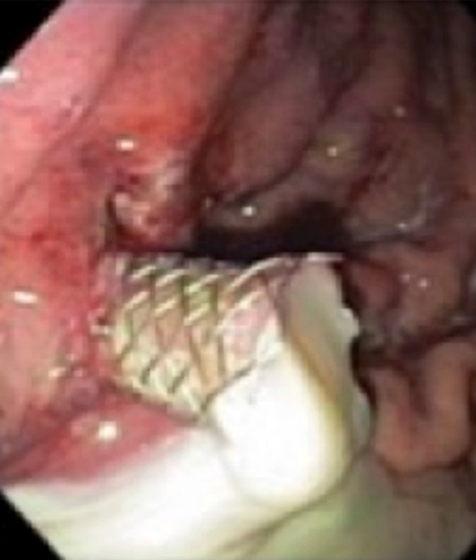 PANCREATIC PSEUDOCYST - TRANSGASTRIC DRAINAGE
