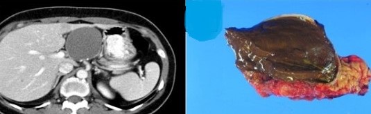 PANCREATIC PSEUDOPAPILLARY TUMOR