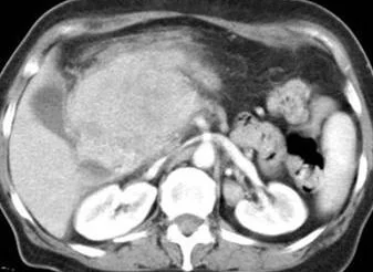 PANCREATIC PSEUDOTUMOR