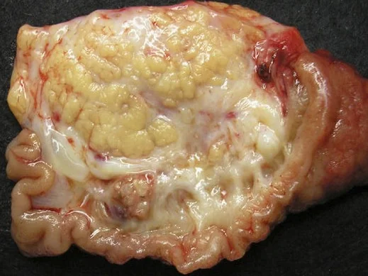 PANCREATIC PSEUDOTUMOR