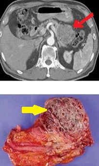 SEROUS PANCREATIC CYSTADENOMA