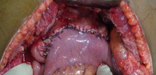 PANCREATICOJEJUNOSTOMY