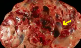 PANCREATOBLASTOMA