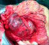 POLYCYSTIC PANCREAS