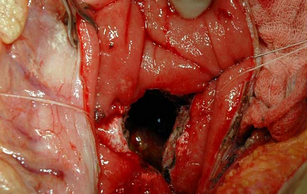 OPENED PANCREATIC PSEUDOCYST