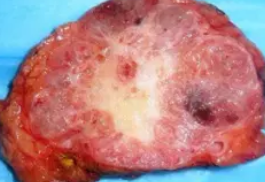 SEROUS CYSTADENOMA