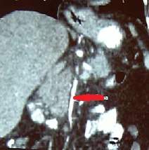 SUPERIOR MESENTERIC ARTERY INFILTRATION