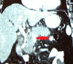SUPERIOR MESENTERIC VEIN INFILTRATION