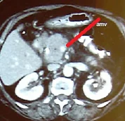SUPERIOR MESENTERIC VEIN INFILTRATION 