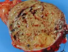 SOLID PSEUDOPAPILLARY TUMOR